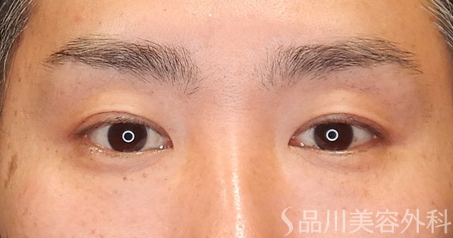 症例NO.75249のBEFORE写真