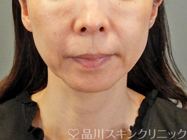 症例NO.66599のBEFORE写真