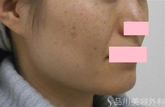 症例NO.24929のBEFORE写真