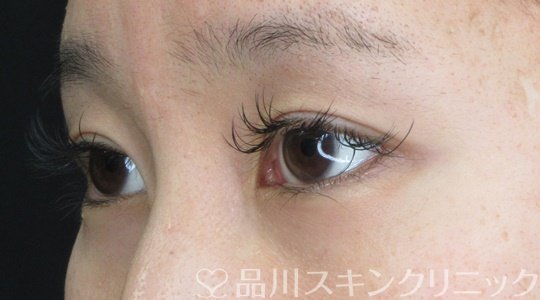 症例NO.71391のBEFORE写真