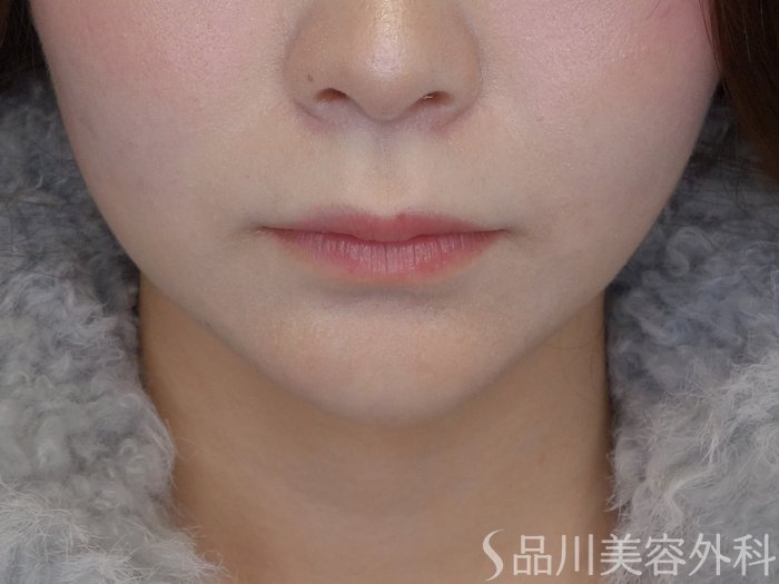 症例NO.72406のAFTER写真