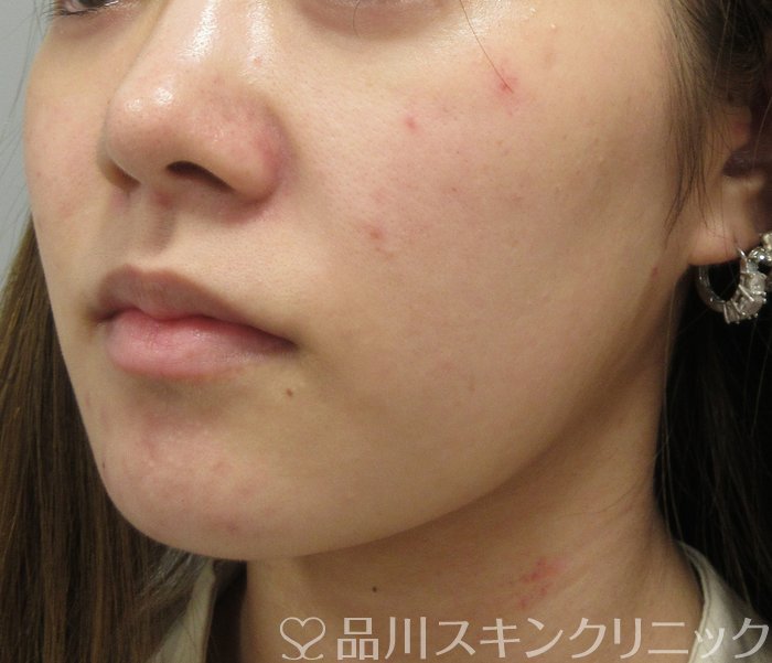 症例NO.74762のBEFORE写真