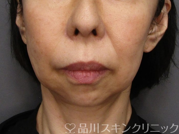 症例NO.75144のBEFORE写真