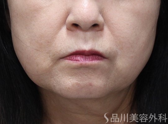症例NO.74634のBEFORE写真
