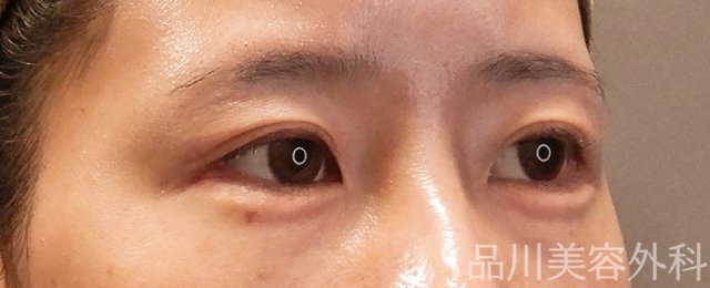 症例NO.70551のAFTER写真