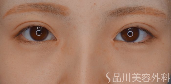 症例NO.75129のAFTER写真