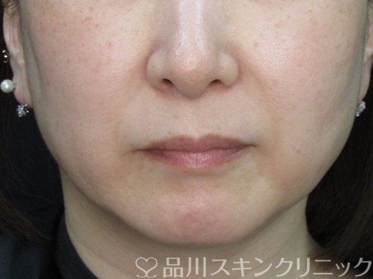 症例NO.74979のBEFORE写真