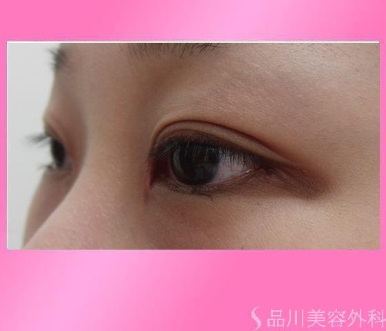 症例NO.7134のAFTER写真