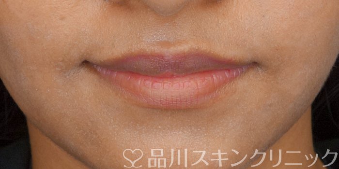 症例NO.72221のBEFORE写真