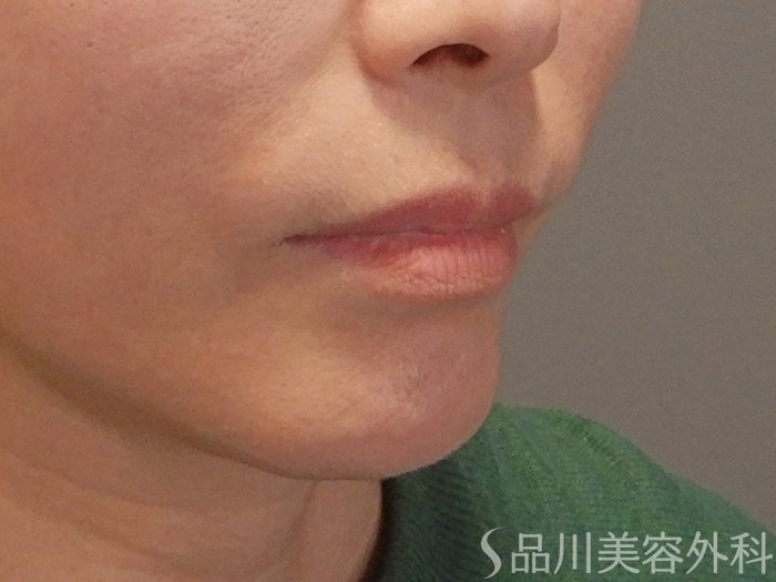 症例NO.69690のBEFORE写真