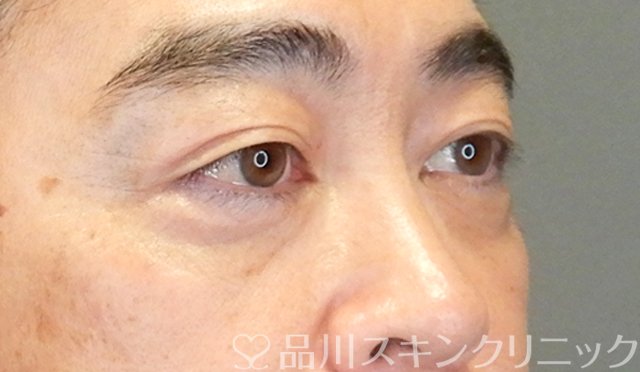 症例NO.65423のAFTER写真