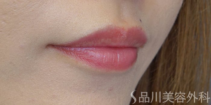 症例NO.71519のBEFORE写真