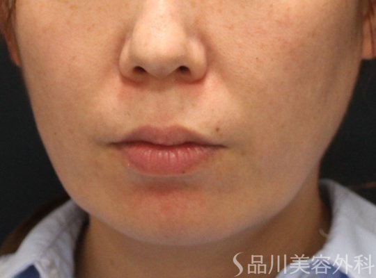 症例NO.74351のBEFORE写真