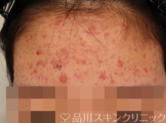 症例NO.72178のBEFORE写真