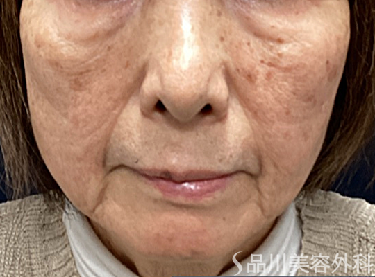 症例NO.73425のBEFORE写真