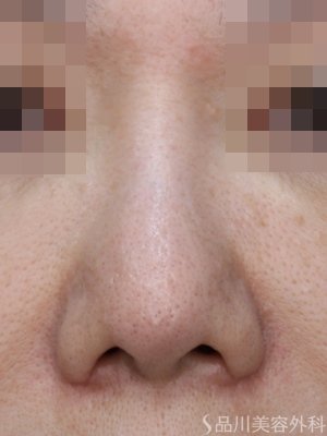 症例NO.74727のAFTER写真