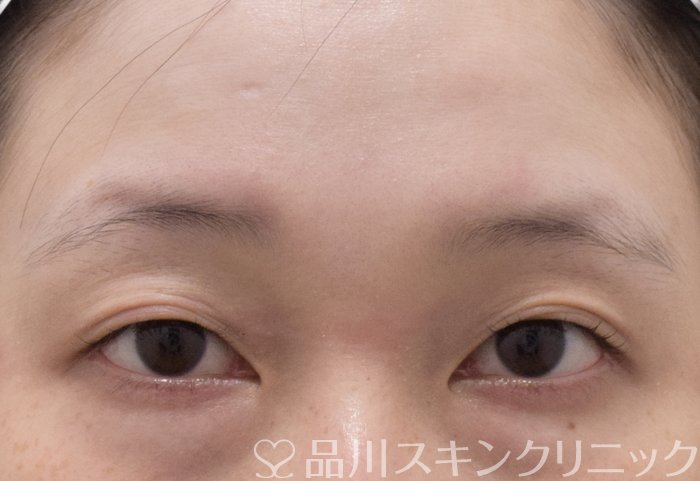 症例NO.73282のBEFORE写真