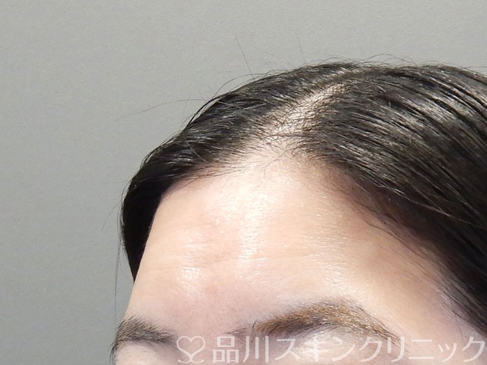 症例NO.72790のBEFORE写真