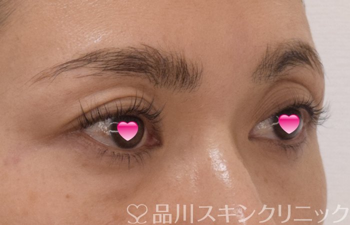 症例NO.74276のBEFORE写真