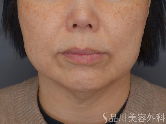 症例NO.72667のBEFORE写真