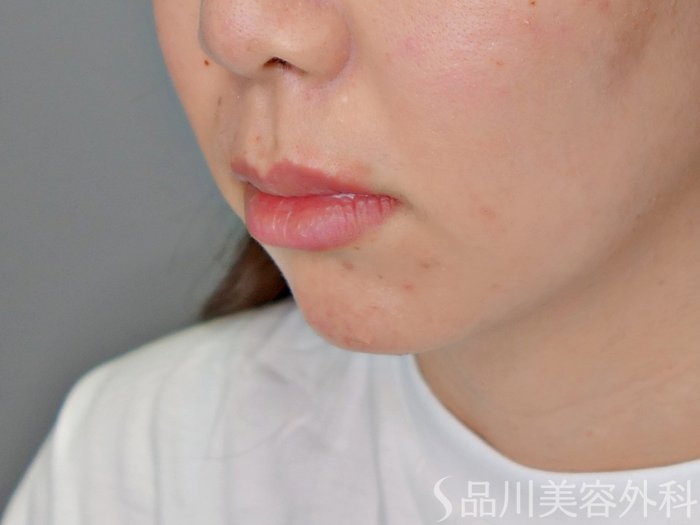 症例NO.70968のAFTER写真