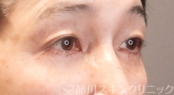 症例NO.63445のAFTER写真