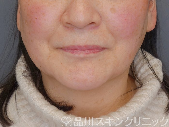 症例NO.72593のBEFORE写真