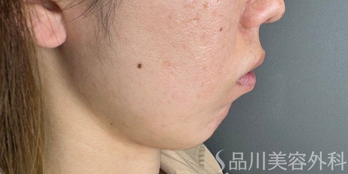 症例NO.64914のBEFORE写真