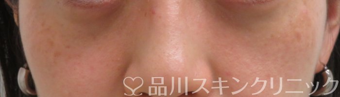 症例NO.66520のAFTER写真