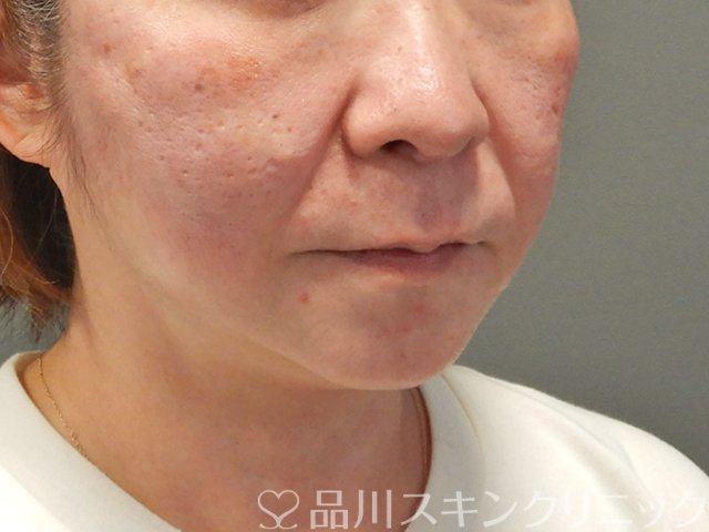 症例NO.75056のAFTER写真