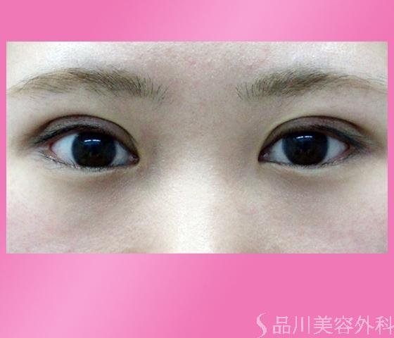症例NO.1180のAFTER写真
