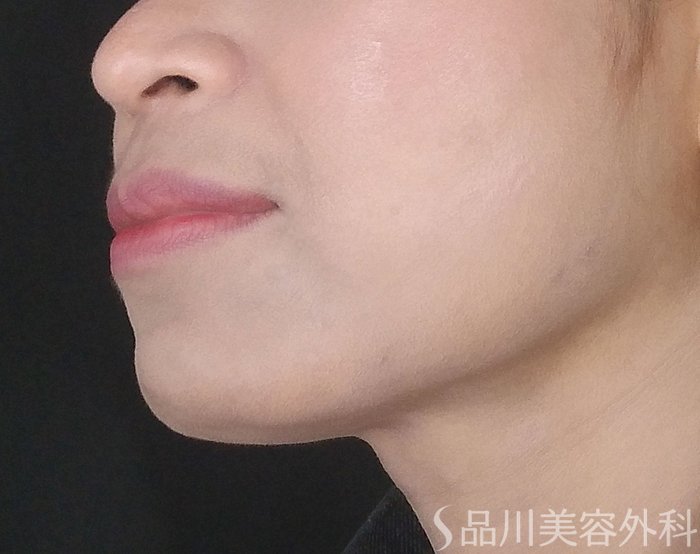 症例NO.69609のAFTER写真