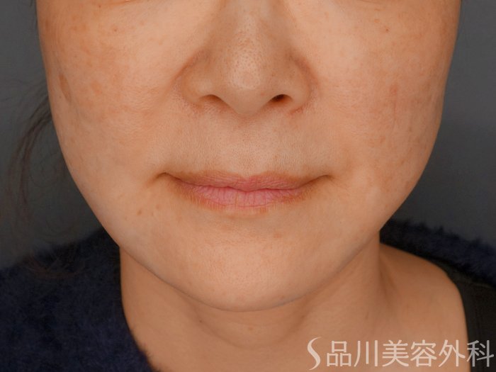 症例NO.73270のAFTER写真