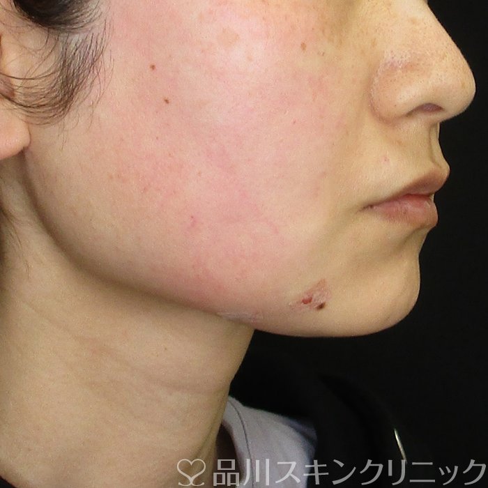 症例NO.74162のAFTER写真