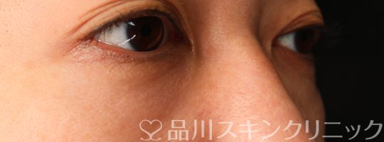 症例NO.69658のBEFORE写真