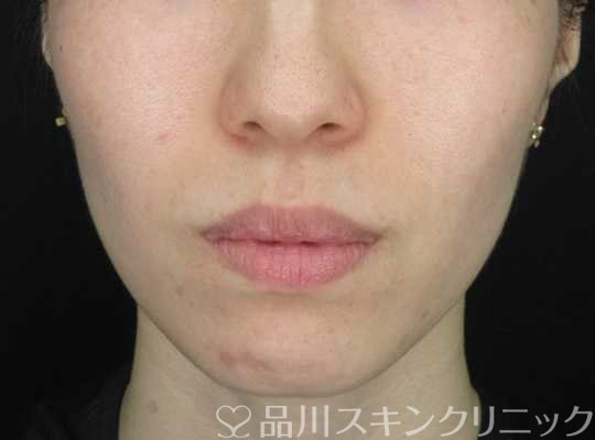 症例NO.67630のBEFORE写真