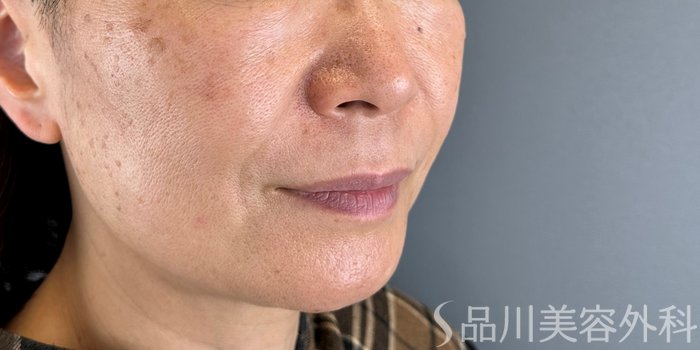 症例NO.70178のAFTER写真