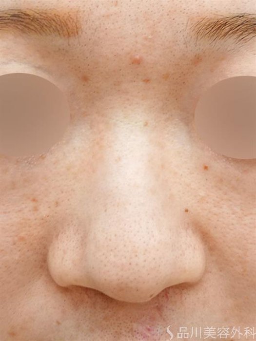 症例NO.46596のBEFORE写真