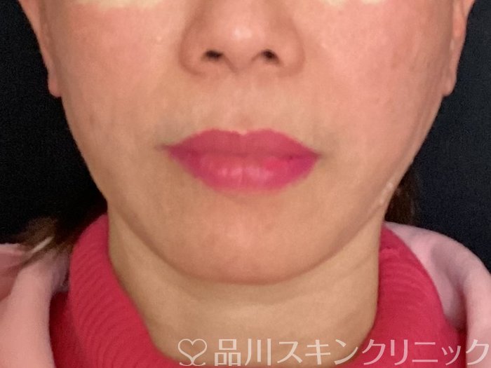 症例NO.65276のAFTER写真