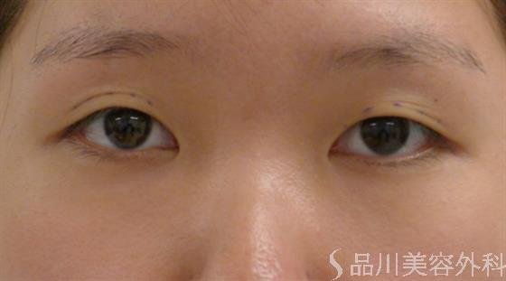症例NO.38310のBEFORE写真