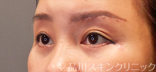 症例NO.70675のAFTER写真