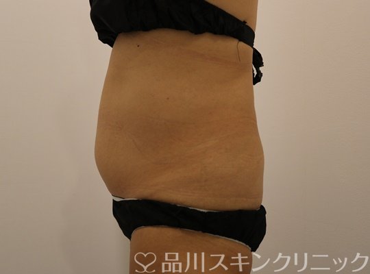 症例NO.68895のBEFORE写真