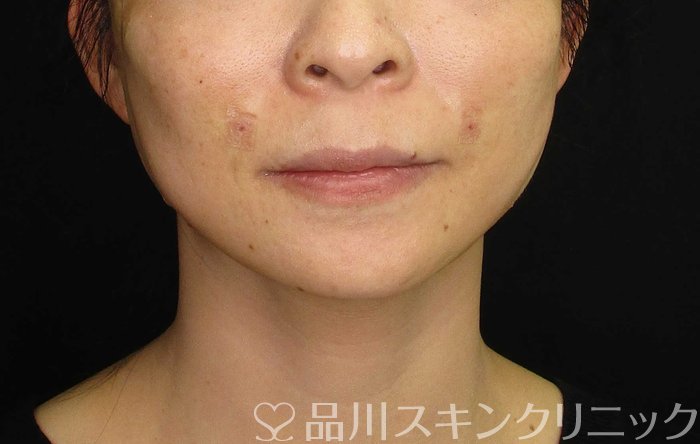 症例NO.62670のAFTER写真