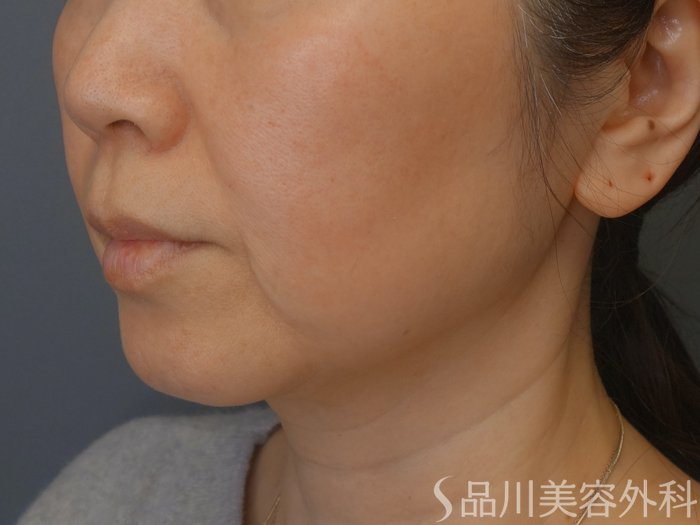 症例NO.69482のBEFORE写真
