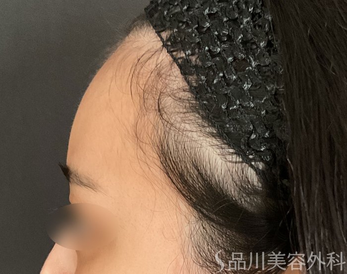 症例NO.75166のBEFORE写真