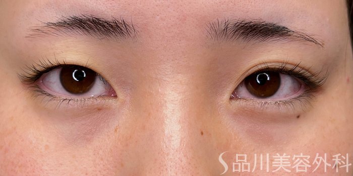 症例NO.74373のBEFORE写真