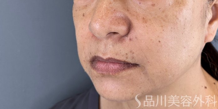 症例NO.71778のAFTER写真