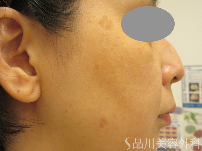 症例NO.75279のBEFORE写真