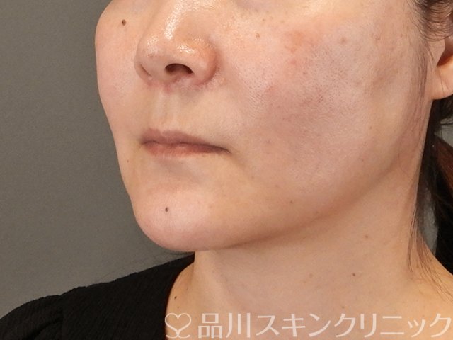 症例NO.75317のAFTER写真