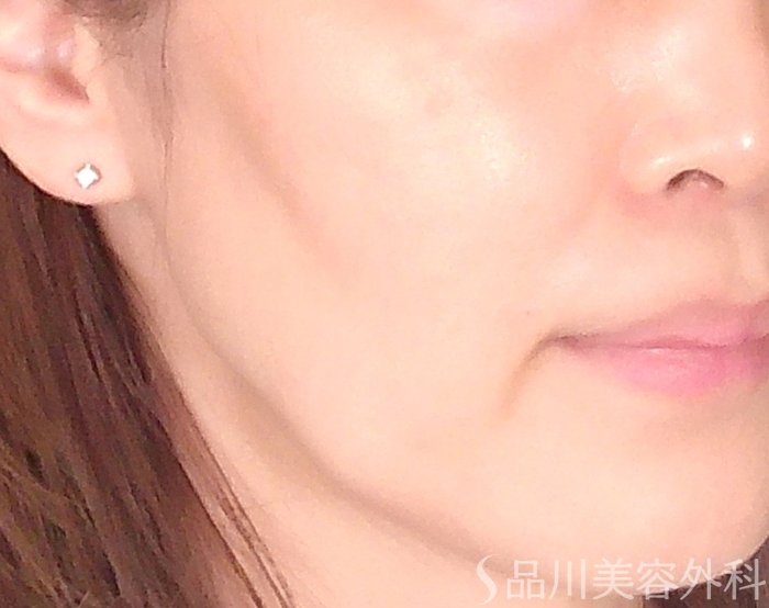 症例NO.70045のBEFORE写真